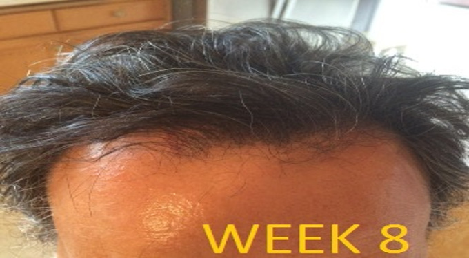 Hairloss Week 8