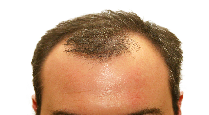 Androgenetic Alopecia