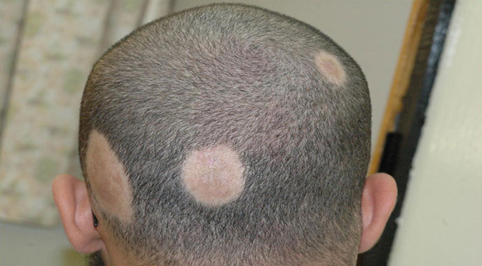 Alopecia Areata
