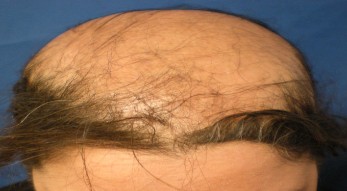 Ciatrical Alopecia