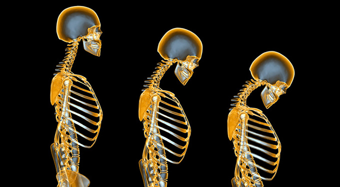 Bone Loss