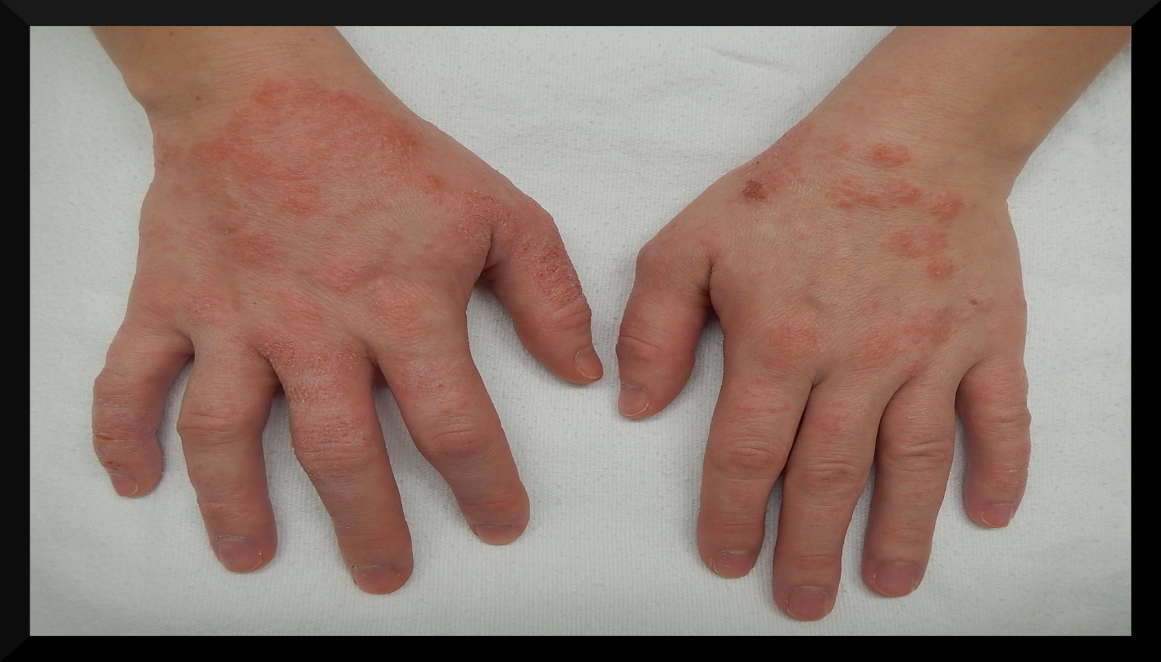 Eczema